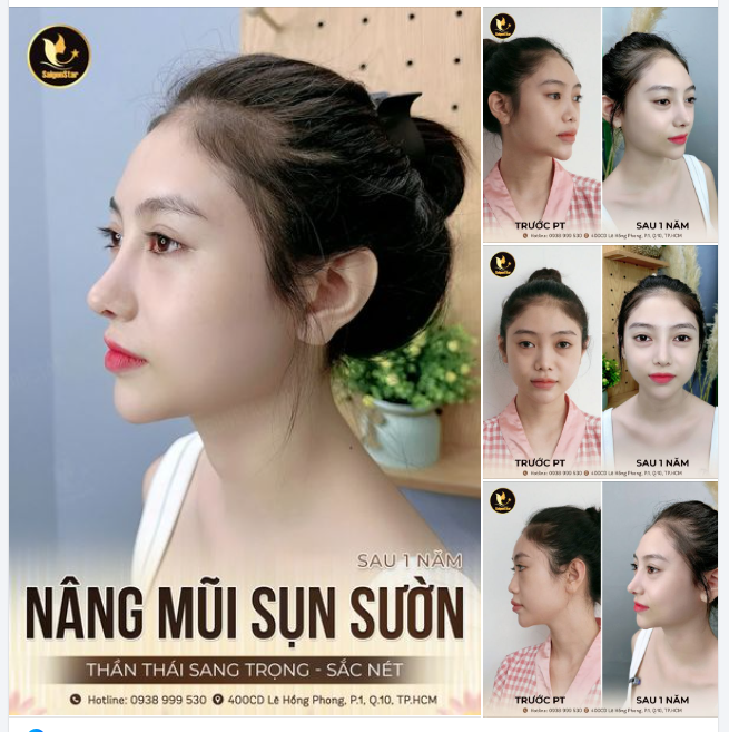 TỰ TIN KHOE NHAN SẮC RẠNG RỠ SAU 1 NĂM NÂNG MŨI SỤN SƯỜN