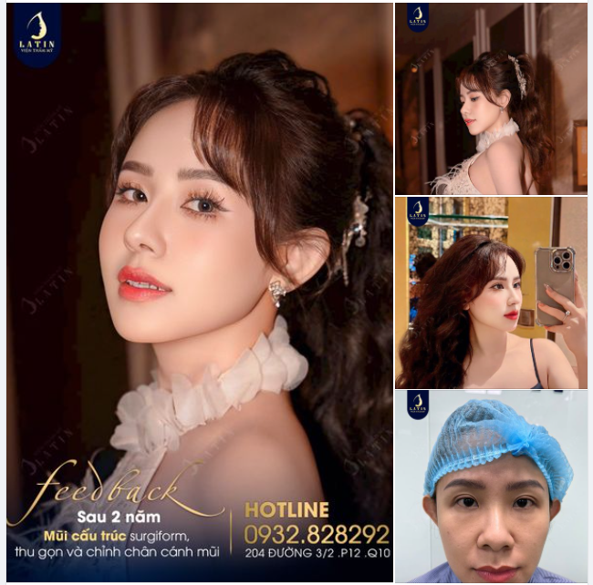 Chiếc mũi cấu trúc surgiform nhà Latin sau 2 năm thực hiện