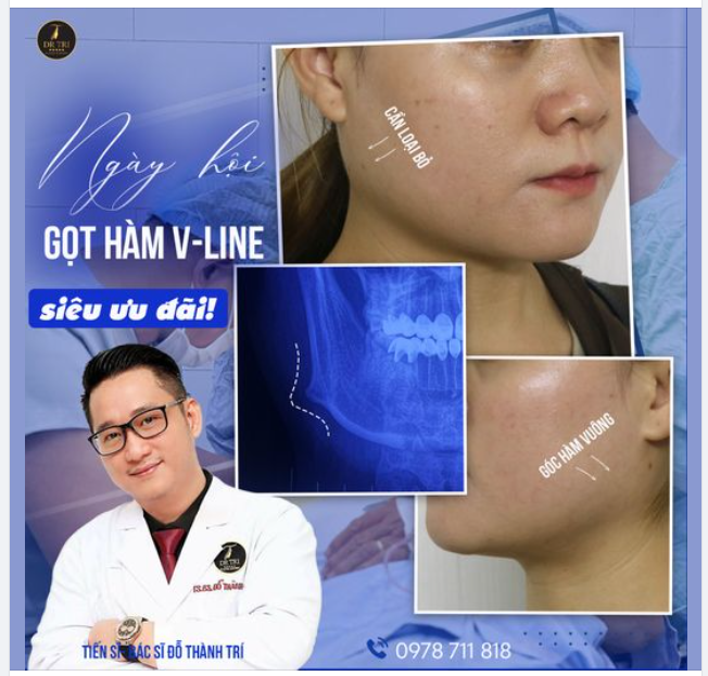 MỘT TUẦN VỚI NHỮNG CA GỌT HÀM VLINE