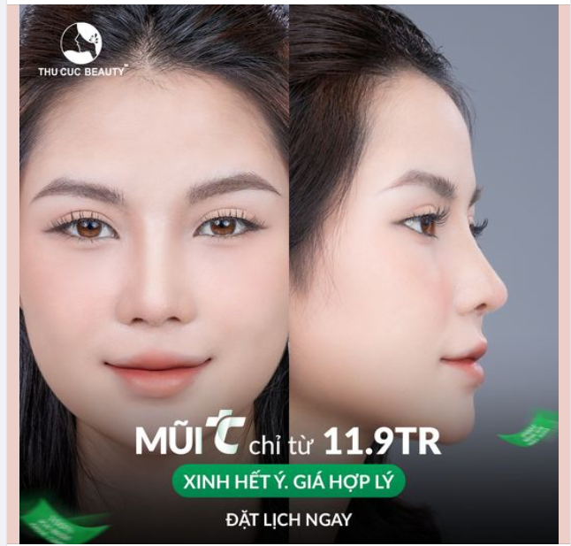 Trước: Sống mũi thấp, đầu mũi to. Sau nâng: Sống mũi cao, đầu mũi thon gọn