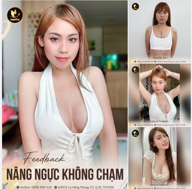 FEEDBACK "ĐỐT MẮT" SAIGON STAR SAU 6 THÁNG NÂNG NGỰC KHÔNG CHẠM