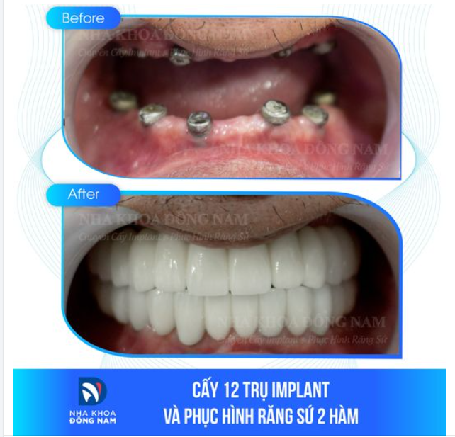 Chú Tùng, một Kiều bào đang sinh sống tại Mỹ, đã có một quyết định quan trọng: trở về quê hương để thực hiện ca trồng răng Implant toàn hàm.