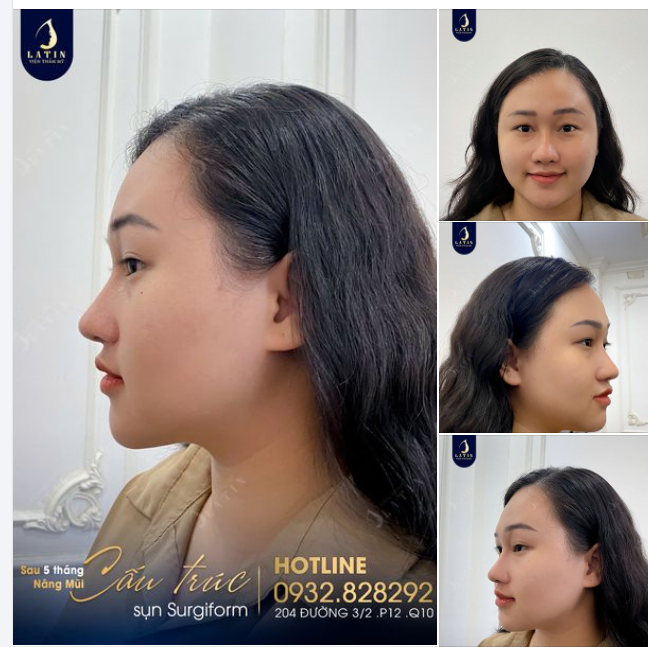 Em gái không nhận ra chính mình sau 5 tháng nâng mũi