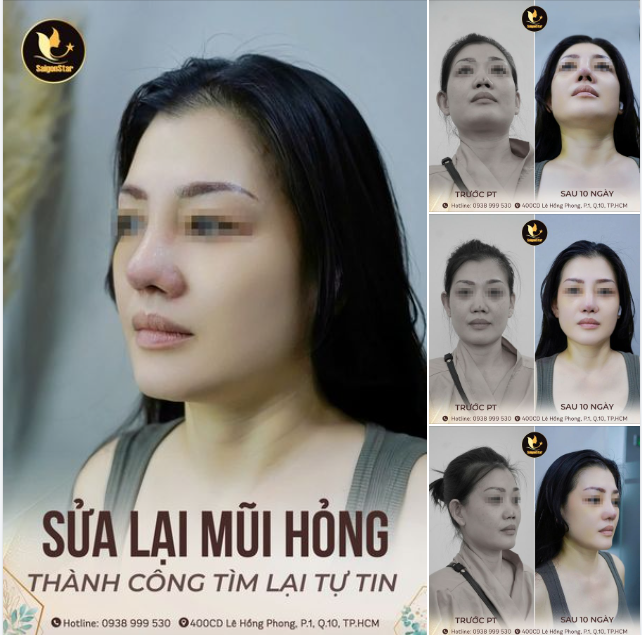 SAU 10 NGÀY SỬA LẠI MŨI HỎNG - THÀNH CÔNG TÌM LẠI TỰ TIN