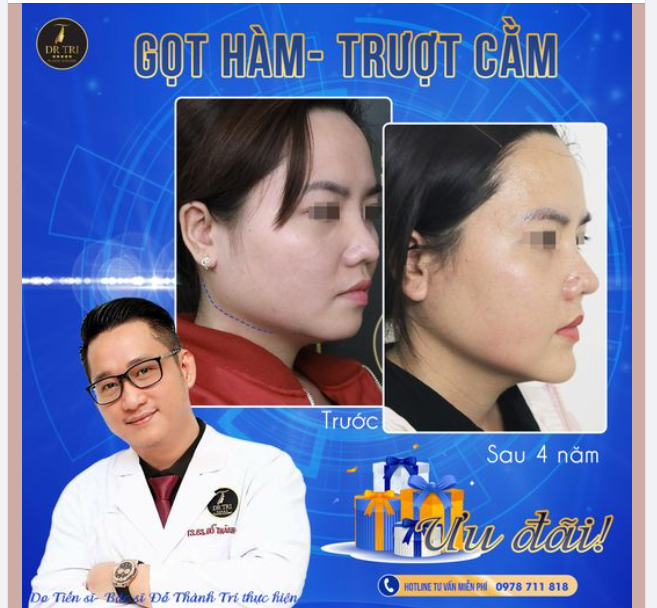 Sau 4 năm Gọt hàm- Trượt cằm, cô gái ấy thay đổi thế nào?