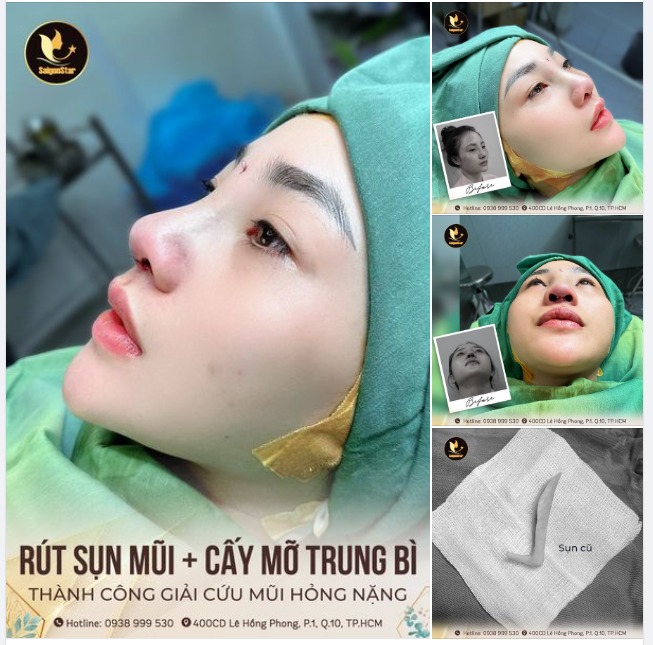 KẾT QUẢ SỬA MŨI HỎNG - TÌM LẠI SỰ TỰ TIN CHỈ SAU 60 PHÚT