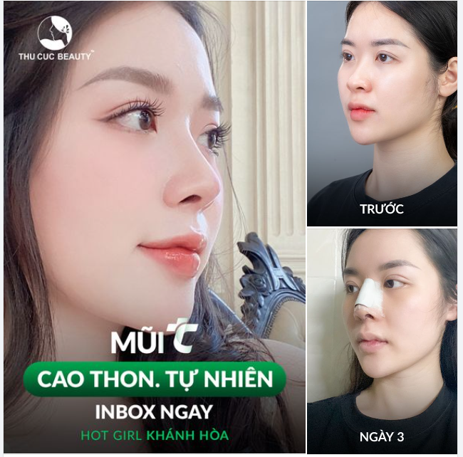 Mũi TC - Dáng mũi tự nhiên. Bền đẹp theo thời gian