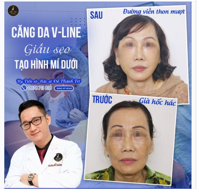 Chỉ 2 tuần trước khách có gương mặt hóp má, hóp thái dương, cung gò má rộng.