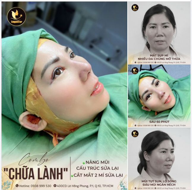 THÀNH CÔNG "CHỮA LÀNH" VỚI COMBO: NÂNG MŨI CẤU TRÚC SỬA LẠI + CẮT MÍ SỬA LẠI