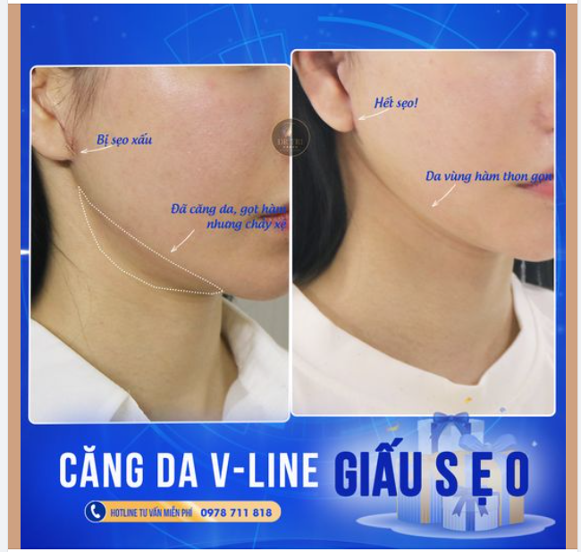 THỞ PHÀO NHẸ NHÕM VÌ XÓA ĐƯỢC SẸO XẤU VÀ LOẠI BỎ DA XỆ CHO CÔ GÁI 2X