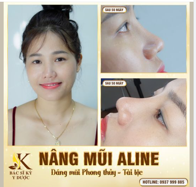 NÂNG CẤP SỰ XINH ĐẸP VỚI CHIẾC MŨI CẤU TRÚC 50 NGÀY TUỔI