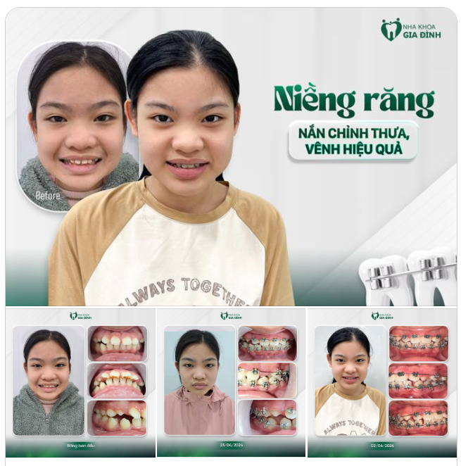 7 THÁNG CHỈNH NHA, NGỠ NGÀNG VỚI SỰ THAY ĐỔI