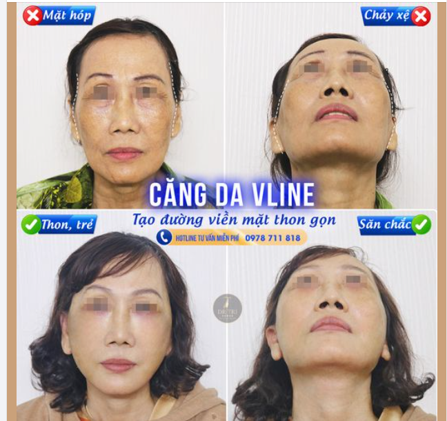 Biến gương mặt hóp má, hóp thái dương, lão hóa độ tuổi U60 thành gương mặt trẻ hơn 10 tuổi với đường viền thon gọn nhờ Căng da VLine giấu sẹo