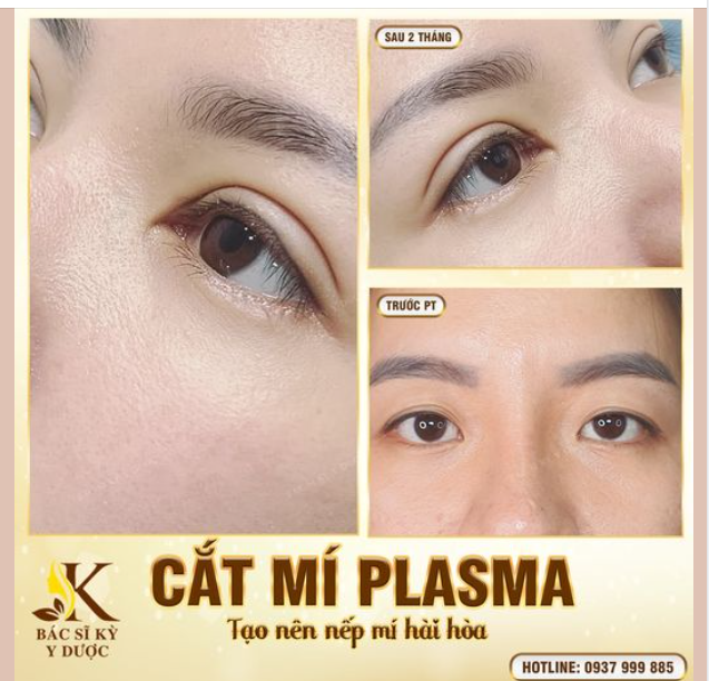 CHÚ Ý! CHÚ Ý! Ở ĐÂY CÓ ĐÔI MẮT ĐẸP SAU 2 THÁNG CẮT MÍ