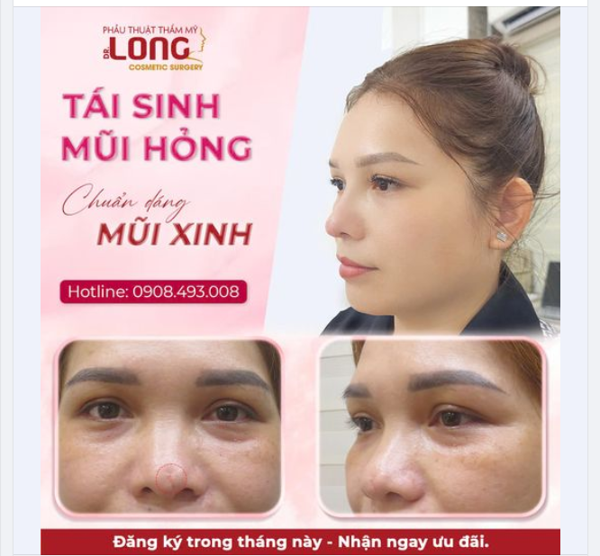 TÁI TẠO MŨI HỎNG  DÁNG MŨI XINH