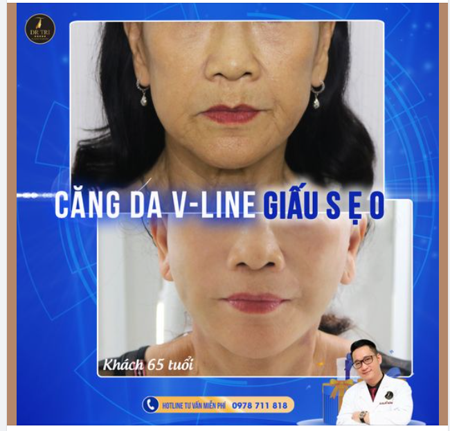 Quá trình sau 14 ngày Gọt góc hàm thô, đem lại đường viền hàm dưới mượt mà sắc nét cho cô gái 28t.