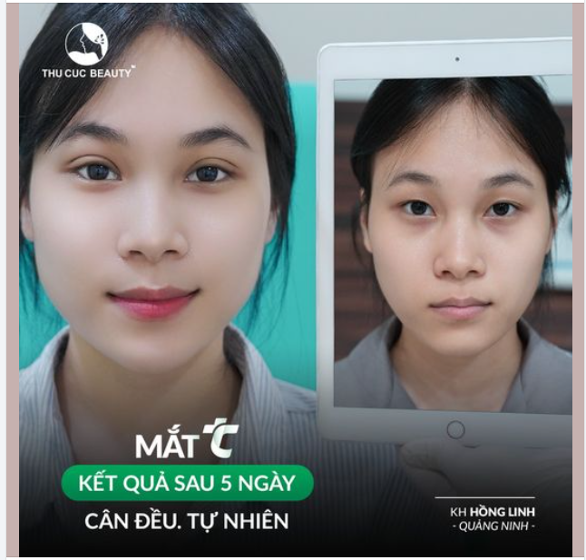 Hình ảnh cắt mí sau 5 ngày