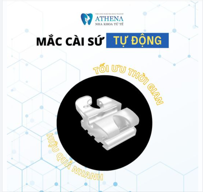 Niềng răng mắc cài sứ tự buộc đang ngày càng trở nên phổ biến và được nhiều người lựa chọn nhờ vào những lợi ích vượt trội mà nó mang lại.