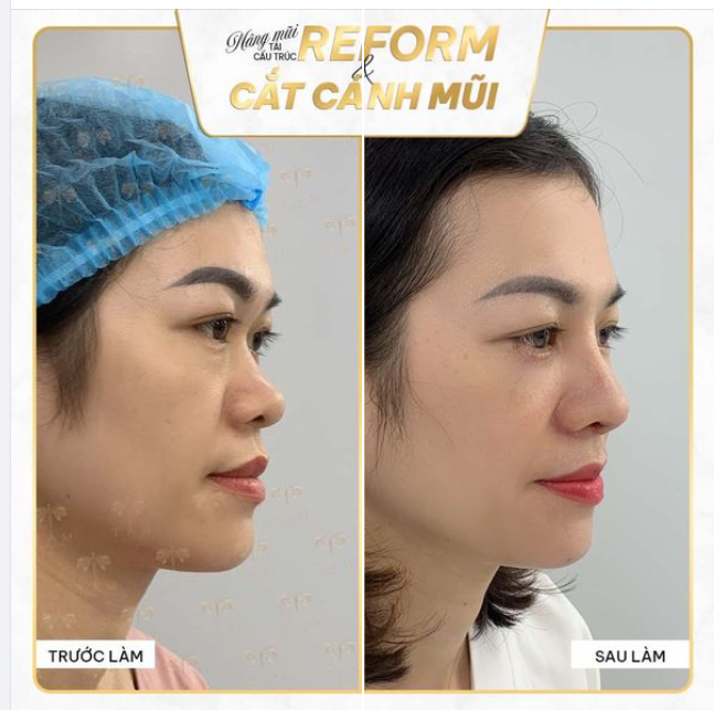 Nâng mũi tái cấu trúc Reform - loại bỏ hoàn toàn mọi khuyết điểm mũi