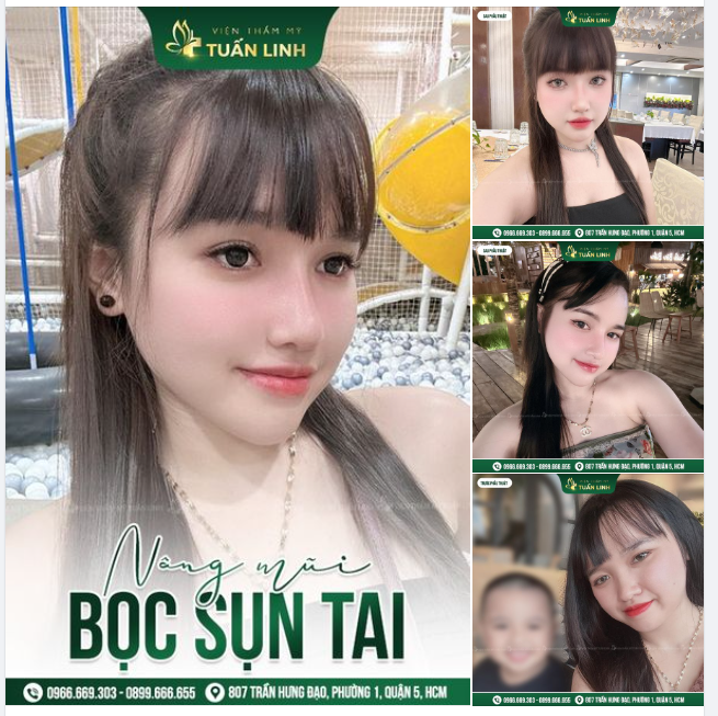 Nâng mũi Sline bọc sụn tai - Phương pháp nâng mũi đơn giản mà xinh sang vô cùng!!