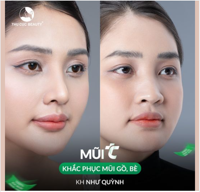 Xóa bỏ tự ti với chiếc mũi tẹt. 30P có ngay dáng mũi thanh tú