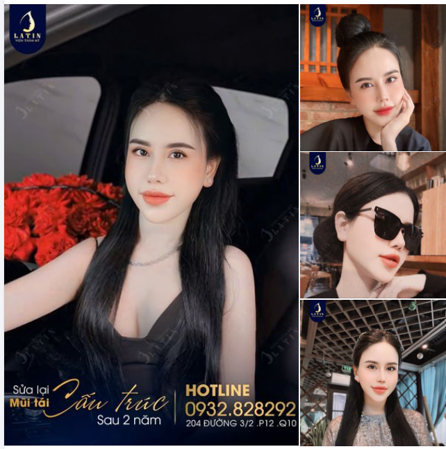 Những hình ảnh xinh đẹp của chị T.L sau 2 năm sửa mũi tại Latin