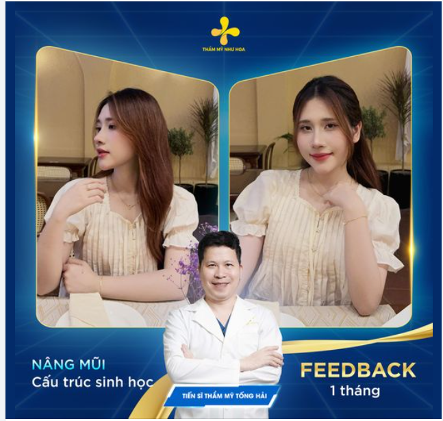 NÂNG MŨI CẤU TRÚC SINH HỌC SAU 1 THÁNG