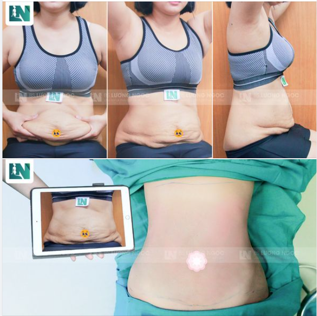 Mỡ thừa tích tụ 10 năm đã khiến chị B.Huyền mặc cảm tự ti rất nhiều với vóc dáng sồ sề, da bụng chảy xệ, chùng nhăn.