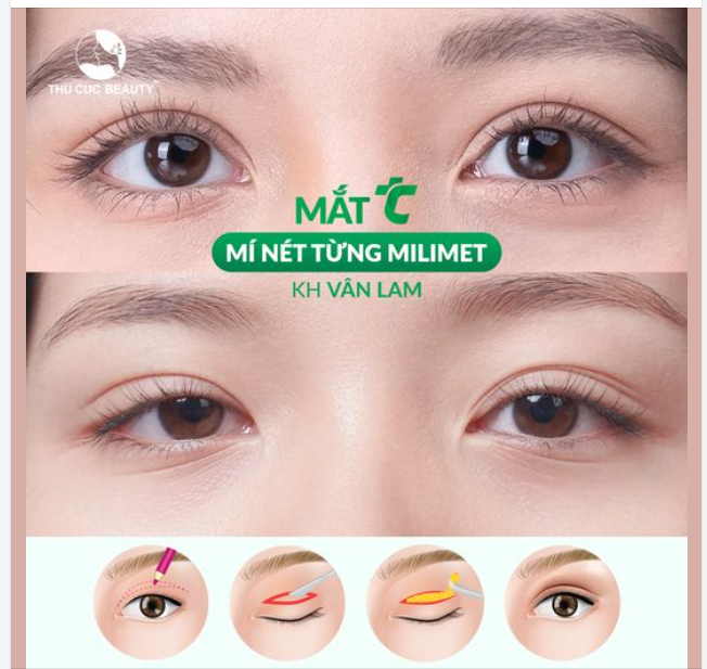 ​​​​​​​Cắt mí Khắc phục mọi tình trạng: một mí, mí lệch, da chùng, nhiều nếp mí,...