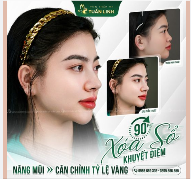 90 phút nâng mũi cấu trúc - Cân chỉnh dáng mũi đẹp chuẩn tỉ lệ vàng!!