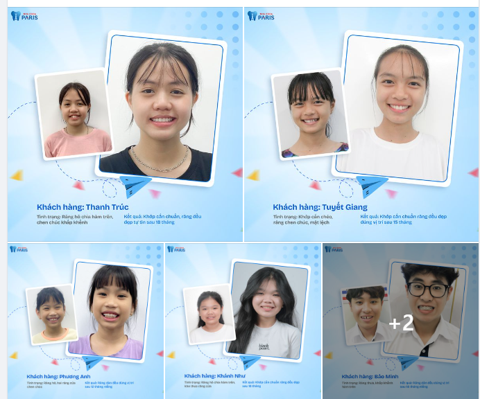 Còn gì vui hơn khi cận kề ngày tựu trường cũng là ngày được tháo niềng nhỉ? Nụ cười tươi rạng rỡ và sự tự tin chính là hành trang quan trọng mà bố mẹ dành tặng cho các con.