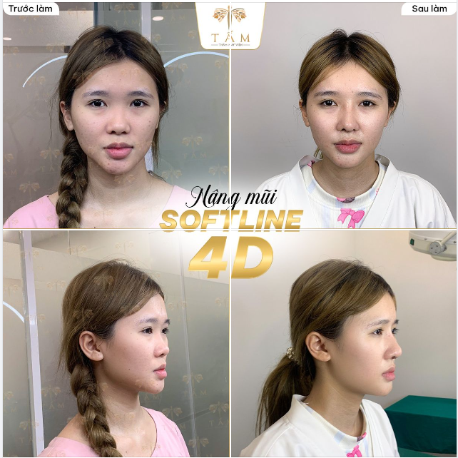 Thế nào được xem là tân trang nhan sắc? Ấy chính là sau khi nâng mũi sở hữu góc thẳng tự nhiên và góc nghiêng xuất sắc.