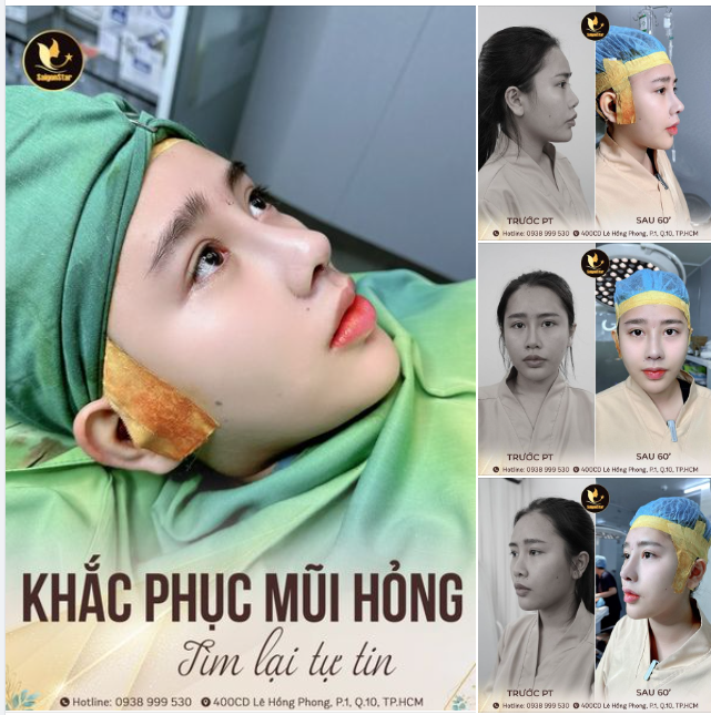 KHẮC PHỤC MŨI HỎNG - THÀNH CÔNG TÌM LẠI SỰ TỰ TIN