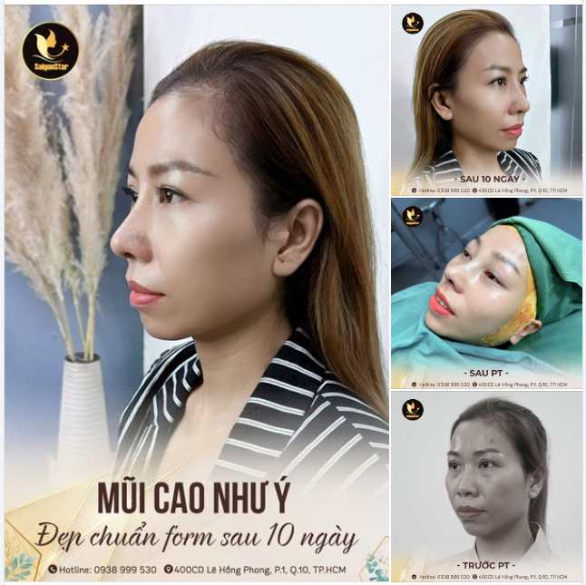 Chỉ cần bỏ ra 60 phút thực hiện - 10 ngày sau có ngay dáng mũi cao như ý, đẹp chuẩn form!