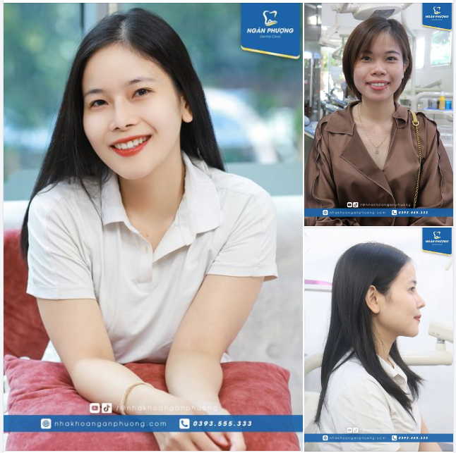 Niềng răng đẹp xuất sắc thế này thì ngại gì không niềng? Nhắn nhủ ngay nha khoa nhận ưu đãi: