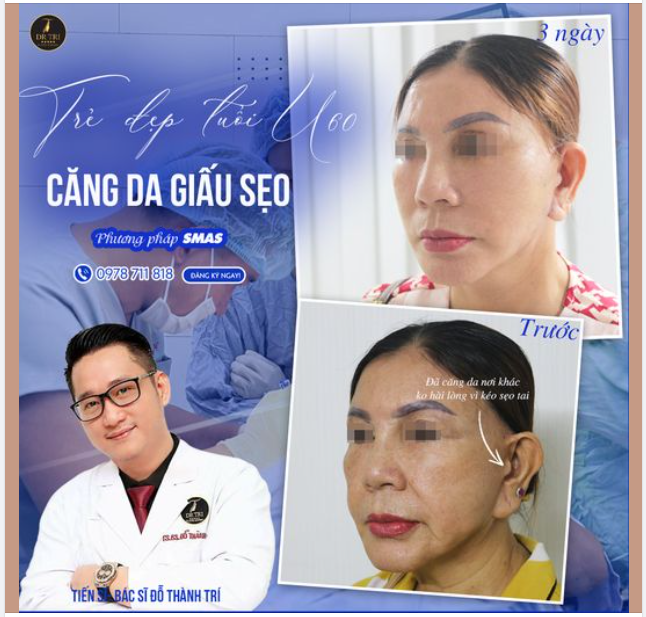 Cô khách U60 từng căng da nhiều năm trước bằng phương pháp cũ và để lại sẹo xấu.