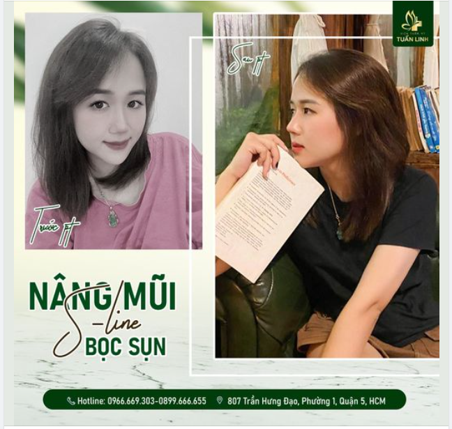 GƯƠNG MẶT XINH HƠN, SẮC NÉT HƠN NHỜ ĐỔI DÁNG MŨI