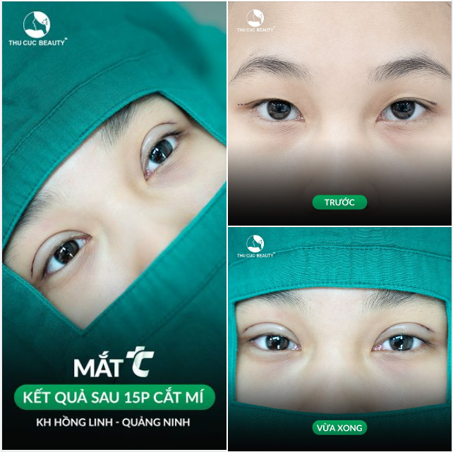 15P có ngay nếp mí đẹp cùng ưu đãi giảm 40%  Chi phí cắt mí không thể hời hơn