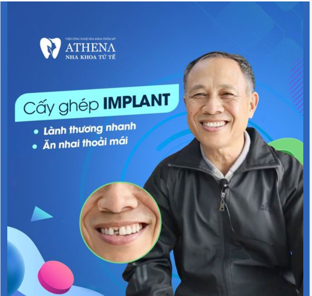 Cấy ghép Implant là giải pháp tối ưu nhất hiện nay để phục hình lại răng đã mất, đảm bảo chức năng ăn nhai y như răng thật: