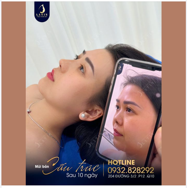 Mũi bán cấu trúc 10 ngày tuổi lên dáng tự nhiên cho chị gái đến từ Tây Ninh