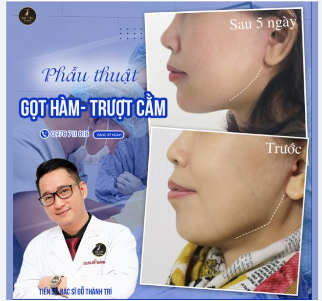 Còn gì vui hơn khi thấy đường viền hàm của khách thon mượt bất chấp hình mộc, mặc dù còn hơi sưng nhẹ sau 5 ngày Gọt hàm Trượt cằm.