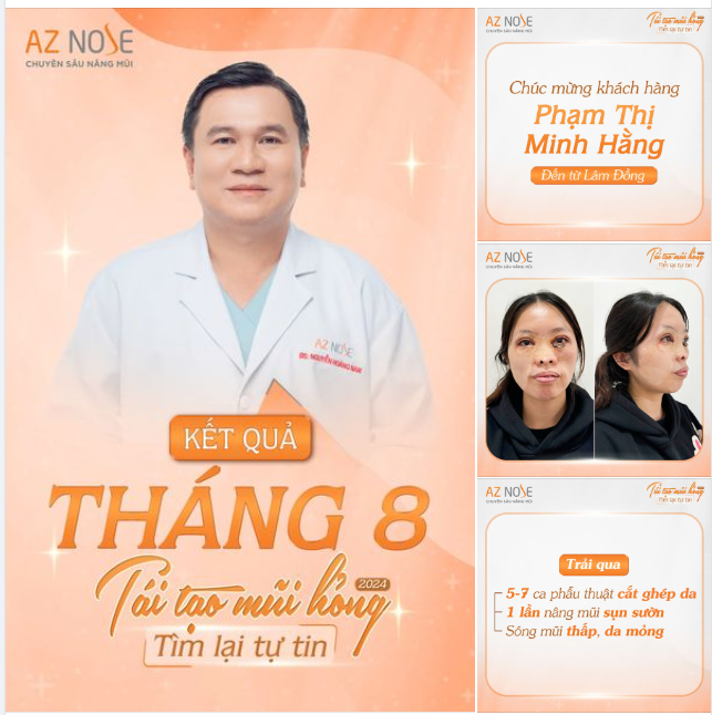 Tái tạo mũi hỏng 2024 Chúc mừng nữ sinh ngành Dược đến từ Lâm Đồng