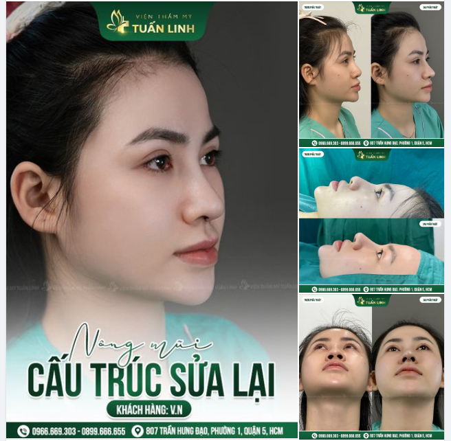 NÂNG CẤP MŨI CẤU TRÚC SAU 8 NĂM NÂNG MŨI BỌC SỤN!!