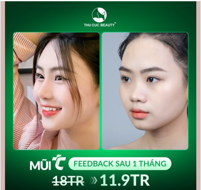 Nâng mũi GIÁ GỐC Mũi TC -35% cho các chị em muốn sở hữu dáng mũi cao thanh tú