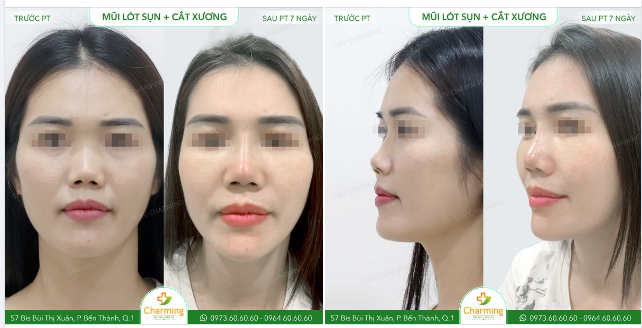 Nàng khách của Charming đây là một trong những trường hợp hi hữu khi đáng ra nên nâng mũi cấu trúc thì bác Khanh lại thực hiện nâng mũi lót sụn kết hợp cắt xương.