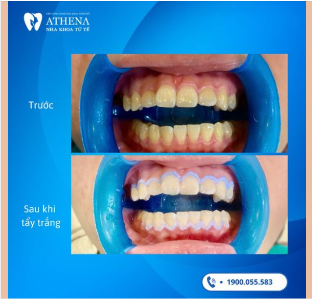 Tẩy trắng răng bằng đèn plasma đang là xu hướng hot trong ngành nha khoa!