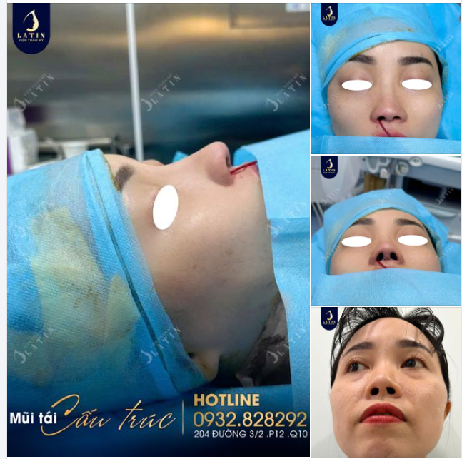 Chị gái vượt hơn 170km để sửa lại dáng mũi ưng ý