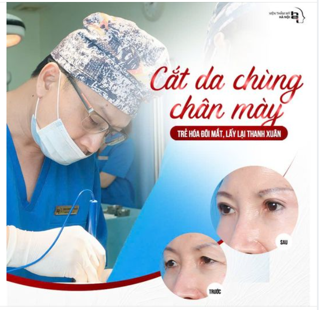 CẮT DA CHÙNG CHÂN MÀY KHÔNG KHÂU DA