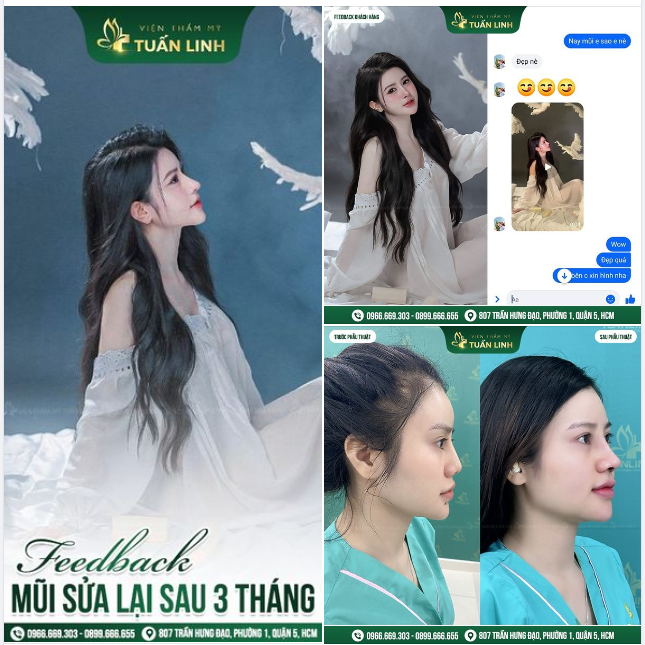 Feedback Nâng mũi cấu trúc sửa lại sau 3 tháng - Chỉ ba từ " ĐẸP XUẤT SẮC"!!