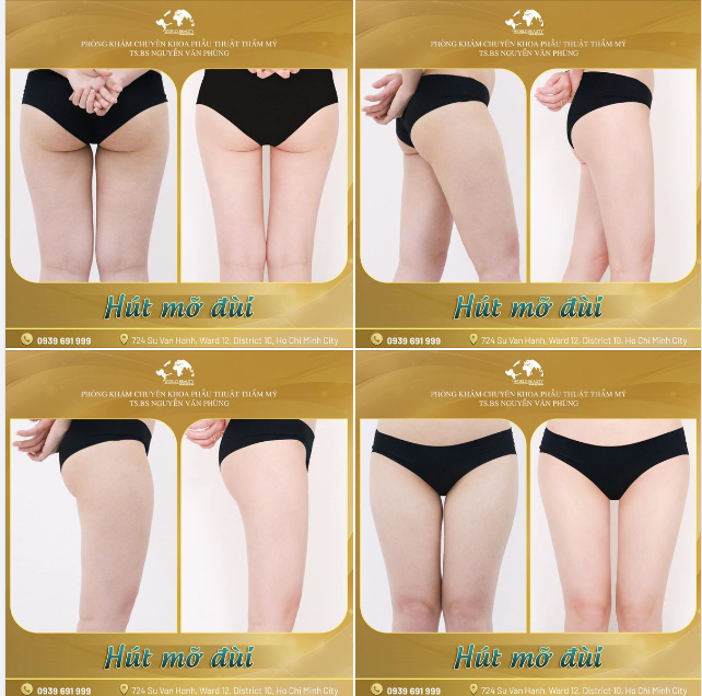 Hút mỡ đùi tạo hình đường nét body với đôi chân thon gọn, săn chắc 